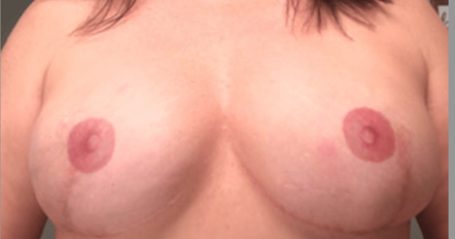 After picture of reconstructed breasts with TataTattoos temporary nipple tattoos after breast cancer mastectomy