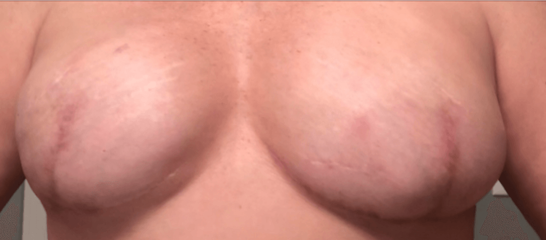 before picture of reconstructed breasts with no nipples after breast cancer mastectomy