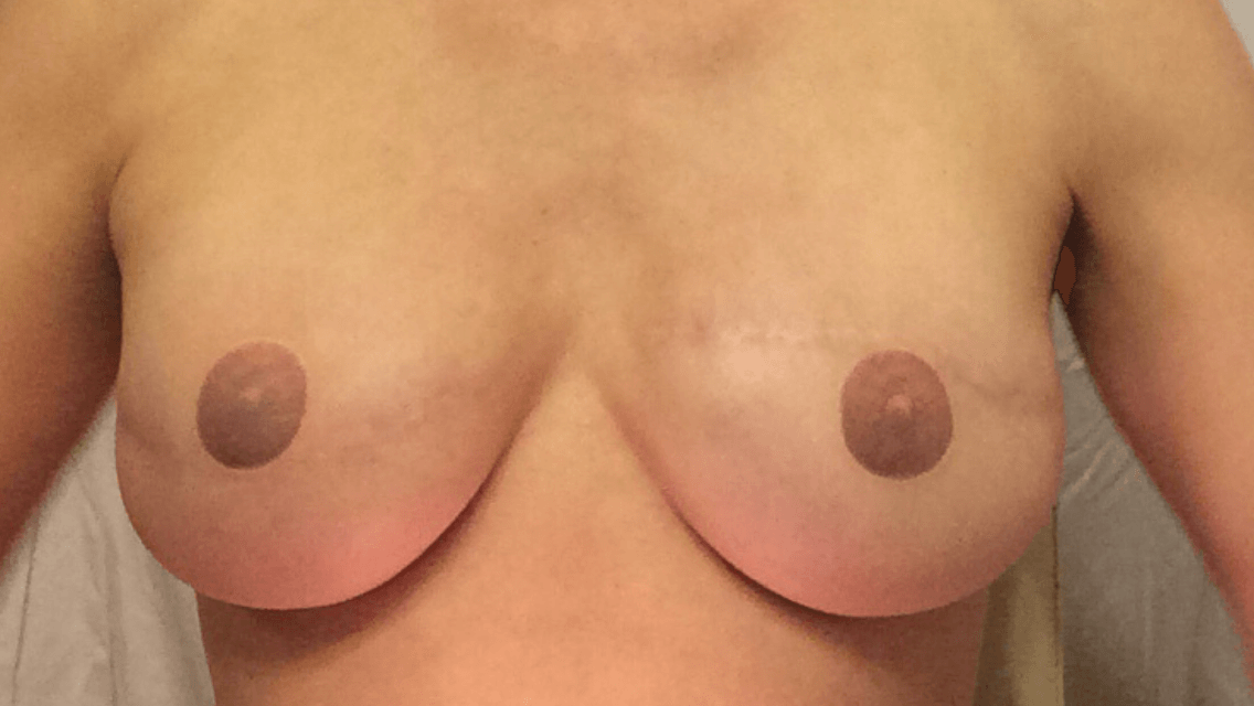 After picture of reconstructed breasts with TataTattoos temporary nipple tattoos after breast cancer mastectomy