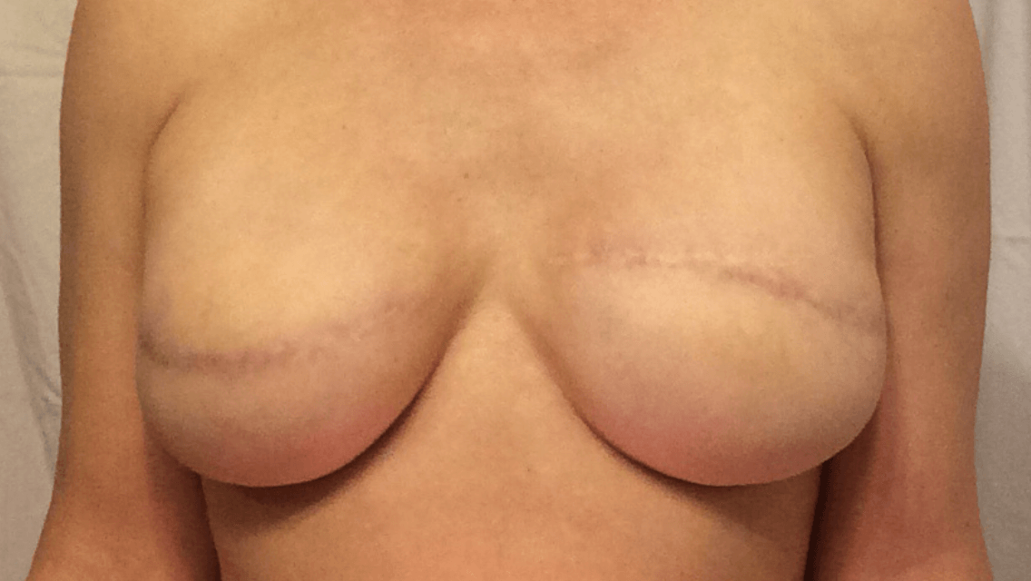 Before picture of reconstructed breasts with TataTattoos temporary nipple tattoos after breast cancer mastectomy